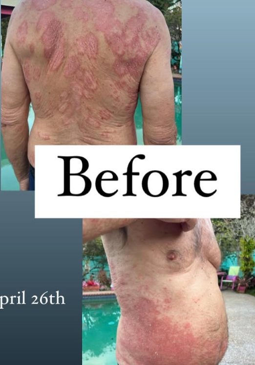 Adult back and side covered in eczema before treatment