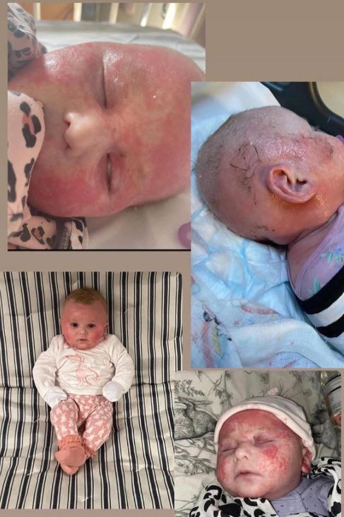 Baby with severe facial eczema before treatment